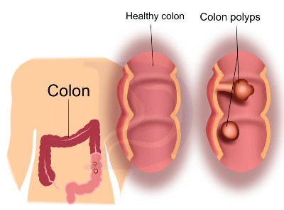 image comparing healthy colon and colon with polyps